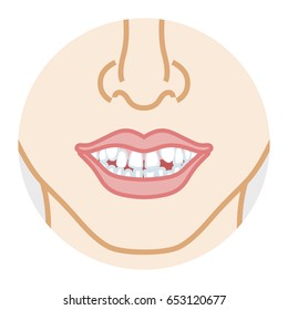 Bad dentition,Face close-up