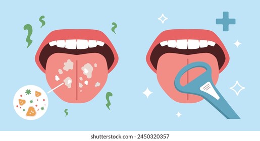 Eliminación de mal olor. Limpieza de la lengua, prevención de la halitosis, higiene bucal, proceso de eliminación de la placa, lucha contra el mal aliento, bacterias, cuidado de la salud de la historieta plana aislada hoy en día concepto de Vector