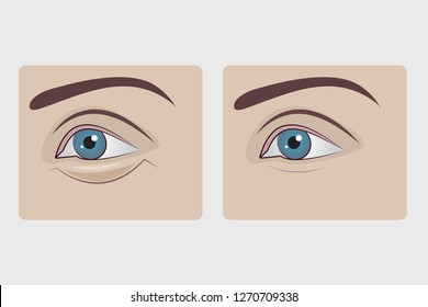 Bags under eyes of woman, plastic surgery to remove hernia under eyes of girl, swollen lower eyelid. Vector illustration