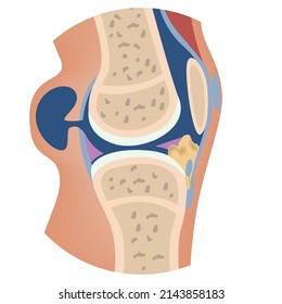 baker's cyst. Anatomy of the knee with damage to the articular capsule and leakage of the synovial substance. Vector illustration