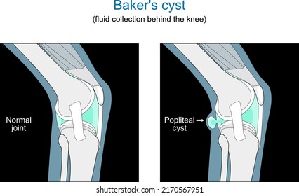 Baker's cyst. fluid collection behind the knee. cross section of Human joint. Flat vector diagram like x-ray illustration.