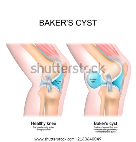 Baker's cyst. Normal knee, and joint with Popliteal cyst. The flow of synovial fluid from the knee joint to the gastrocnemio-semimembranosus bursa. vector illustration Stock foto © 