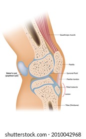 Baker's cyst or popliteal cyst. Traumatology and orthopedics