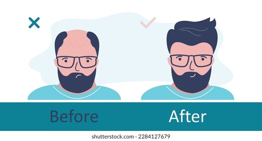 Hombre calvo antes y después del trasplante de pelo. Persona infeliz con problemas de pérdida de pelo, alopecia, vista frontal. Cirugía de trasplante de pelo. Cabello sano. La cirugía de resolución de problemas de calvicie en la cabeza. vector plano