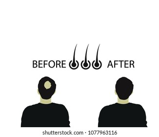 a bald man before and after bald head of a man on white background