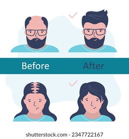 Bald woman and man before and after hair transplantation. Unhappy persons with hair loss problem, alopecia. Hair transplant surgery. Healthy hair. Head baldness problem solving surgery, infographic.