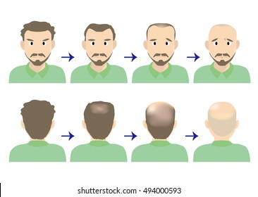 balding head middle men