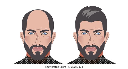 Baldness in man, male with bald head, before and after hair transplantation, male alopecia, plastic surgery, treatment. Vector illustration