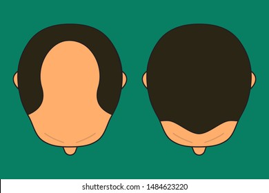 Baldness in man, male with bald head, before and after hair transplantation, male alopecia, plastic surgery, treatment, top view. Vector illustration