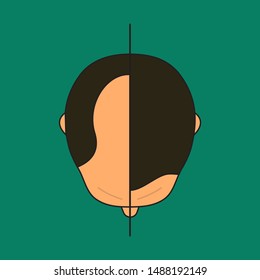 Baldness In Man, Male With Bald Head, Before And After Hair Transplantation, Male Alopecia, Plastic Surgery, Treatment Top View. Vector Illustration