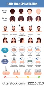 Baldness of men and women methods of hair transplantation set with infographic elements isolated vector illustration