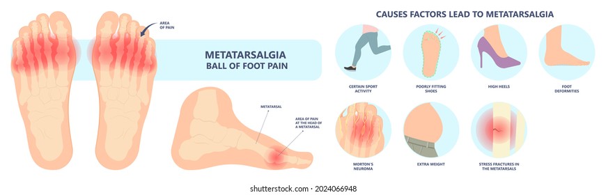 Ball Foot Feet Sport Injury Shoes Toe Ache Runner High Big Heels Hammer Swollen Morton Bone Nerve Head Gout Turf Bursitis Ill Joint Hallux Stiff Tear Achilles Standing Spurs Rupture Bursitis