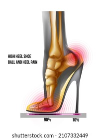 Ball of foot pain high heel shoe X ray bones skeleton realistic illustration. Medial view. Anatomy of joints, human leg transparente skeleton. Weight distribution. For medical orthopedic advertising. 