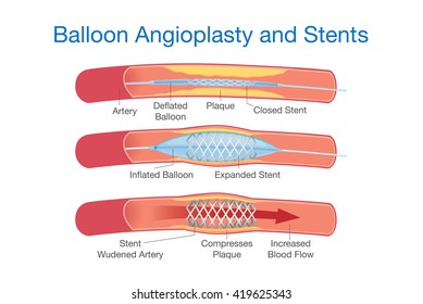 Balloon angioplasty and stents procedure for heart disease treatment. This illustration about medical.