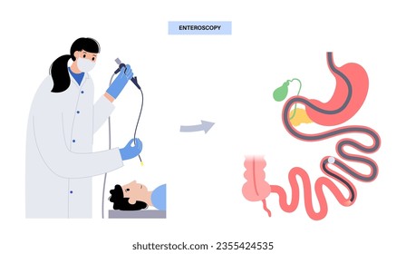 Balloon assisted enteroscopy. Visualization of the small intestine nonsurgical procedure. Gastrointestinal tract exam. Biopsy, polyp removal, bleeding therapy or stent placement vector illustration