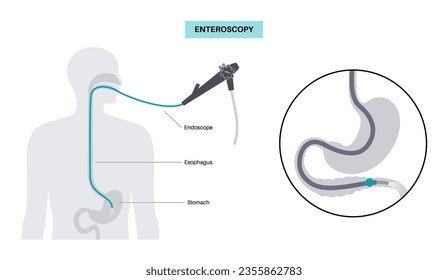 Balloon assisted enteroscopy. Visualization of the small intestine nonsurgical procedure. Gastrointestinal tract exam. Biopsy, polyp removal, bleeding therapy or stent placement vector illustration