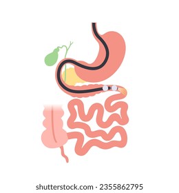 Balloon assisted enteroscopy. Visualization of the small intestine nonsurgical procedure. Gastrointestinal tract exam. Biopsy, polyp removal, bleeding therapy or stent placement vector illustration