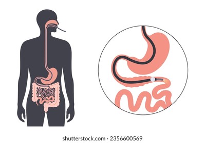 Balloon assisted enteroscopy. Visualization of the small intestine nonsurgical procedure. Gastrointestinal tract exam. Biopsy, polyp removal, bleeding therapy or stent placement vector illustration