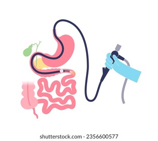 Balloon assisted enteroscopy. Visualization of the small intestine nonsurgical procedure. Gastrointestinal tract exam. Biopsy, polyp removal, bleeding therapy or stent placement vector illustration