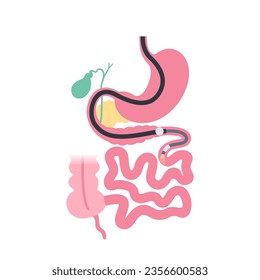 Balloon assisted enteroscopy. Visualization of the small intestine nonsurgical procedure. Gastrointestinal tract exam. Biopsy, polyp removal, bleeding therapy or stent placement vector illustration