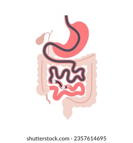 Balloon assisted enteroscopy. Visualization of the small intestine nonsurgical procedure. Gastrointestinal tract exam. Biopsy, polyp removal, bleeding therapy or stent placement vector illustration