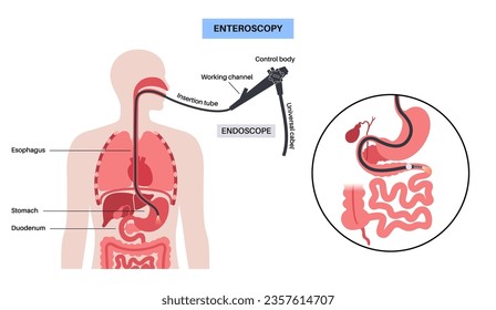 Balloon assisted enteroscopy. Visualization of the small intestine nonsurgical procedure. Gastrointestinal tract exam. Biopsy, polyp removal, bleeding therapy or stent placement vector illustration