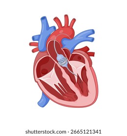 TAVR (Balloon Expanded Transcatheter Aortic Valve Replacement)-Abbildung