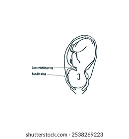 Bandl's ring and constriction ring obstetric drawing vector