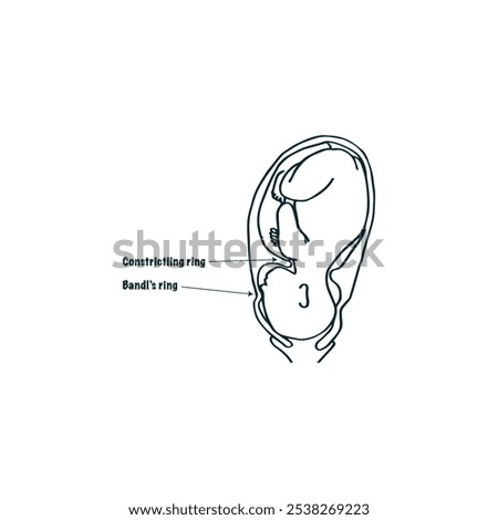 Bandl's ring and constriction ring obstetric drawing vector