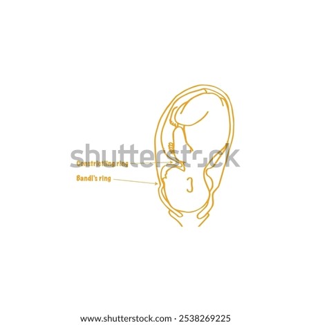 Bandl's ring and constriction ring obstetric drawing vector