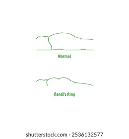 Vetor de ginecologia de ilustração de anel de Bandl