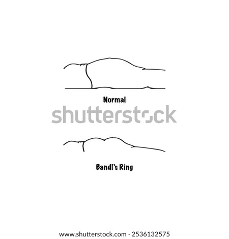 Bandl's Ring Illustration Gynaecology Vector