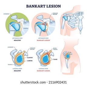 Bankart lesion as anterior part of the glenoid labrum trauma outline diagram. Labeled educational medical injury type with anterior and lateral view of xray with bones and tears vector illustration.