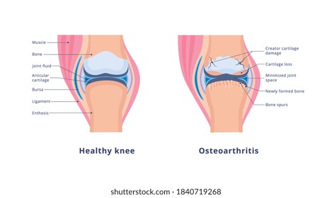 Banner with detailed medical human anatomy with knee osteoarthritis and normal healthy joint. Chronic painful disease of the cartilage and bone. Vector flat illustration on white.