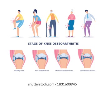 Banner with people suffering from leg pain and infographics of stages knee osteoarthritis. Concept of medicine, diseases of bones and joints, human anatomy. Vector flat illustration