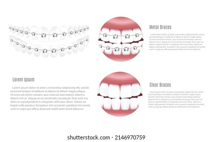 Banner or poster design for dentistry showing metal and clear dental braces, realistic vector illustration. Orthodontic medicine banner layout with copy space for text.