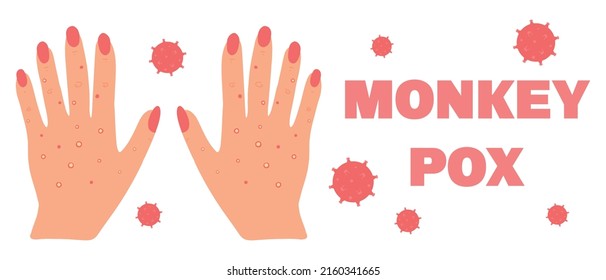 Banner with smallpox monkey. Monkeypox. Hands with a rash. Smallpox symptom. Vector illustration.