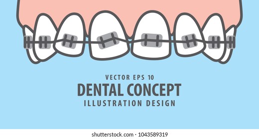 Banner Upper Braces teeth illustration vector on blue background. Dental concept.