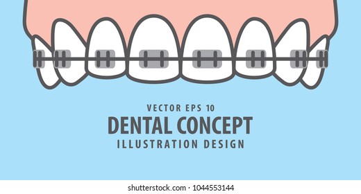 Banner Upper Braces teeth illustration vector on blue background. Dental concept.