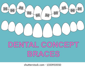 Banner Upper Braces teeth illustration vector on blue background. Dental concept
