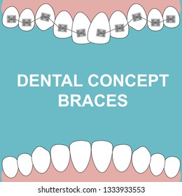 Banner Upper Braces teeth illustration vector on blue background. Dental concept