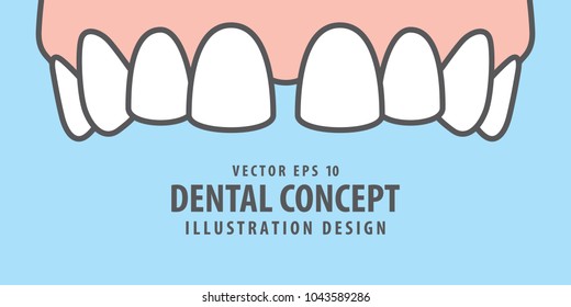 Banner Oberdiastema Zähne Illustration Vektorgrafik auf blauem Hintergrund. Zahnkonzept.