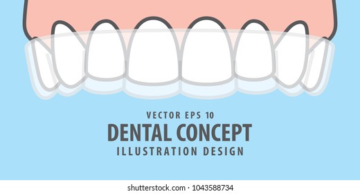 Banner Upper Essix retainer illustration vector on blue background. Dental concept.