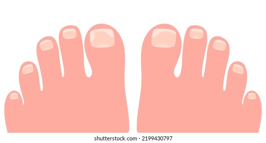 Pie desnudo con onicólisis en una ilustración vectorial de las uñas de los pies. Infección fúngica de las uñas