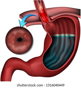 Barett Esophagus Disease Medical Vector Illustration On White Background