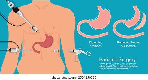 La cirugía bariátrica se realiza cuando la dieta y el ejercicio no han funcionado o cuando tienen problemas de salud graves debido al peso. Ilustración vectorial médica y de atención médica.