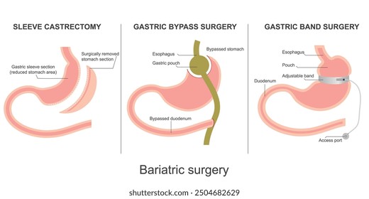 Cirugía bariátrica aislada sobre fondo. Cirugía de bypass gástrico, cirugía de banda gástrica, gastrectomía en manga, Ilustración vectorial médica y de atención médica.