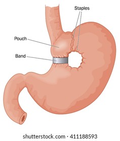 Bariatric surgery showing gastric pouch, band and staples to reduce food intake.