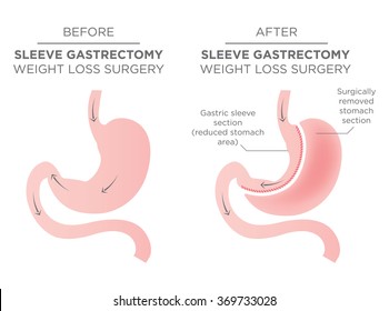 Bariatric Surgery - Sleeve Gastrectomy