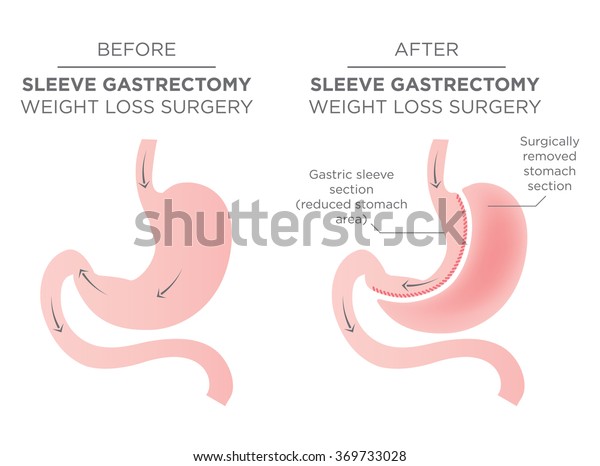 Bariatric Surgery Sleeve Gastrectomy Stock Vector (Royalty Free) 369733028